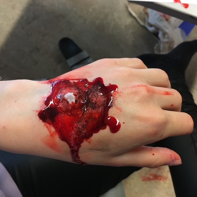 Åbent knoglebrud førstehjælp